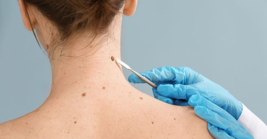 Healthcare professional examining a woman’s neck for a mole (MODELS)